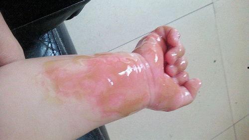 腿被烫伤的图片,腿烫伤紧急处理与康复护理指南